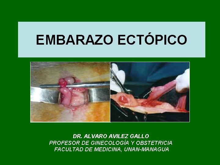 EMBARAZO ECTÓPICO DR. ALVARO AVILEZ GALLO PROFESOR DE GINECOLOGÍA Y OBSTETRICIA FACULTAD DE MEDICINA,