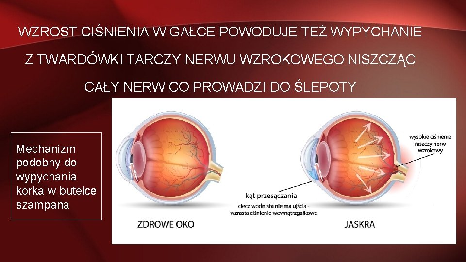 WZROST CIŚNIENIA W GAŁCE POWODUJE TEŻ WYPYCHANIE Z TWARDÓWKI TARCZY NERWU WZROKOWEGO NISZCZĄC CAŁY