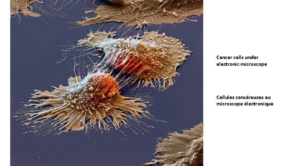 Cancer cells under electronic microscope Cellules cancéreuses au microscope électronique 