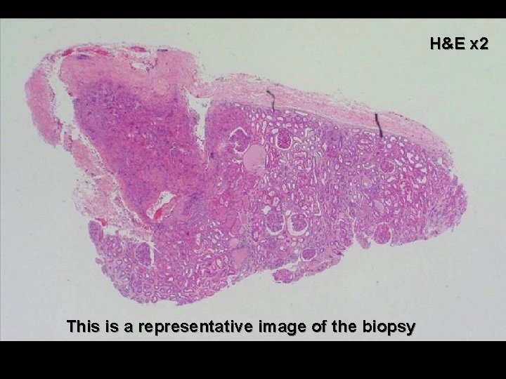 H&E x 2 This is a representative image of the biopsy 