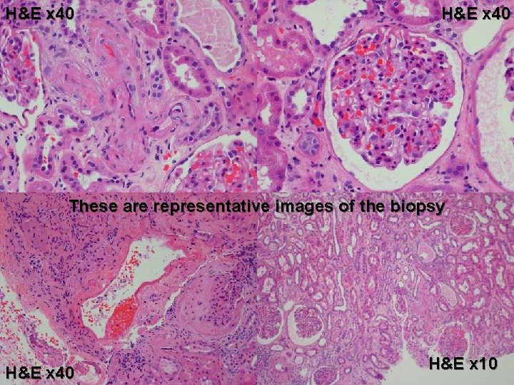 H&E x 40 These are representative images of the biopsy H&E x 40 H&E