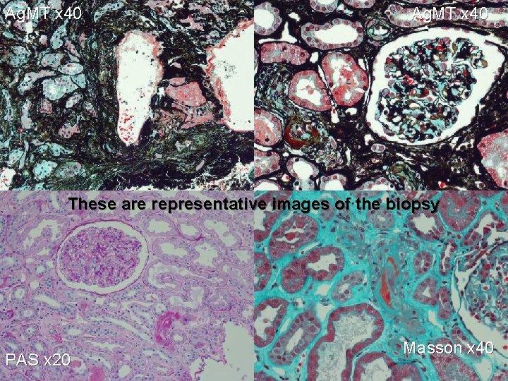 Ag. MT x 40 These are representative images of the biopsy PAS x 20