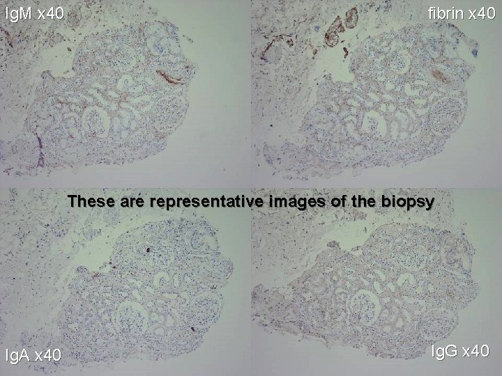 Ig. M x 40 fibrin x 40 These are representative images of the biopsy