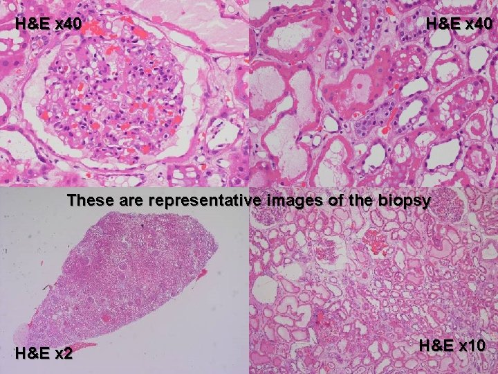 H&E x 40 These are representative images of the biopsy H&E x 2 H&E