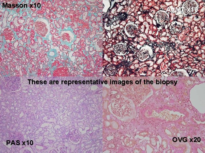 Masson x 10 Ag. MT x 10 These are representative images of the biopsy