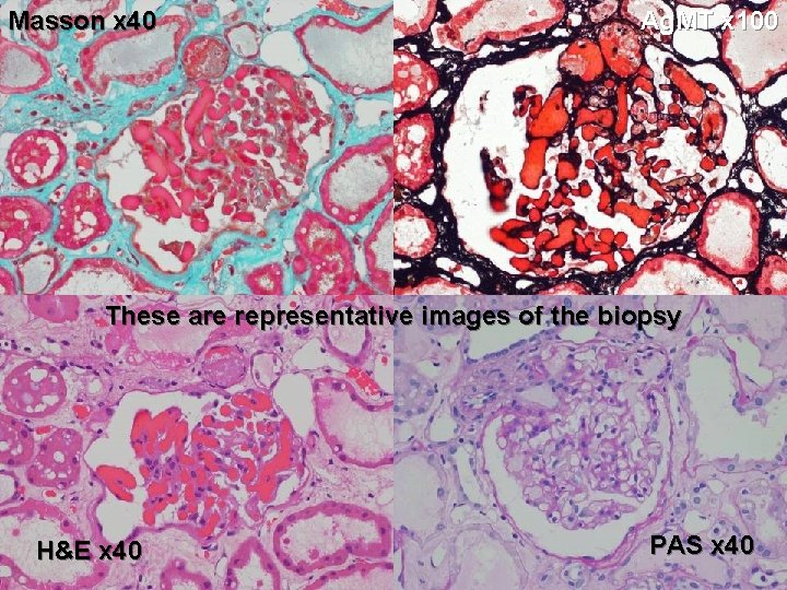 Masson x 40 Ag. MT x 100 These are representative images of the biopsy