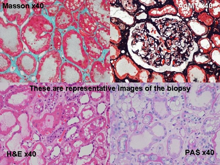 Masson x 40 Ag. MT x 40 These are representative images of the biopsy