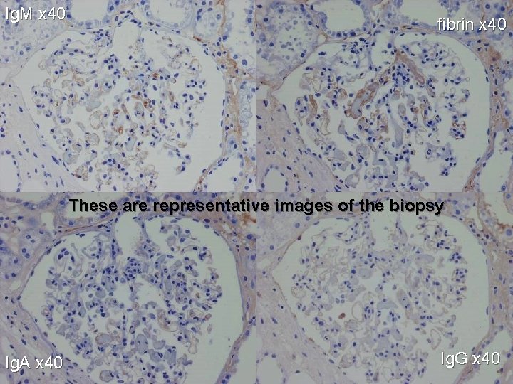 Ig. M x 40 fibrin x 40 These are representative images of the biopsy