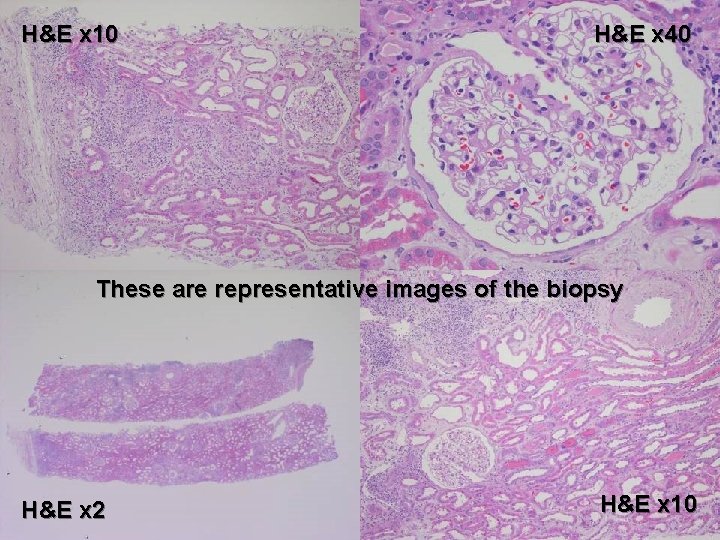 H&E x 10 H&E x 40 These are representative images of the biopsy H&E