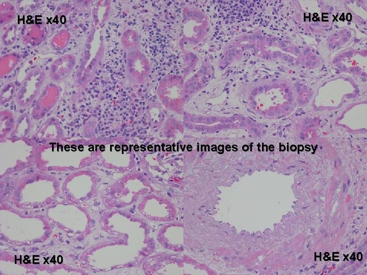 H&E x 40 These are representative images of the biopsy H&E x 40 