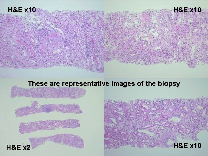 H&E x 10 These are representative images of the biopsy H&E x 2 H&E