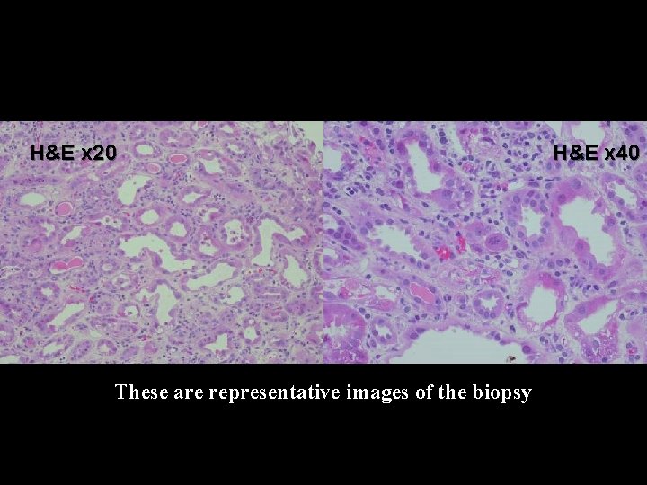 H&E x 20 These are representative images of the biopsy H&E x 40 