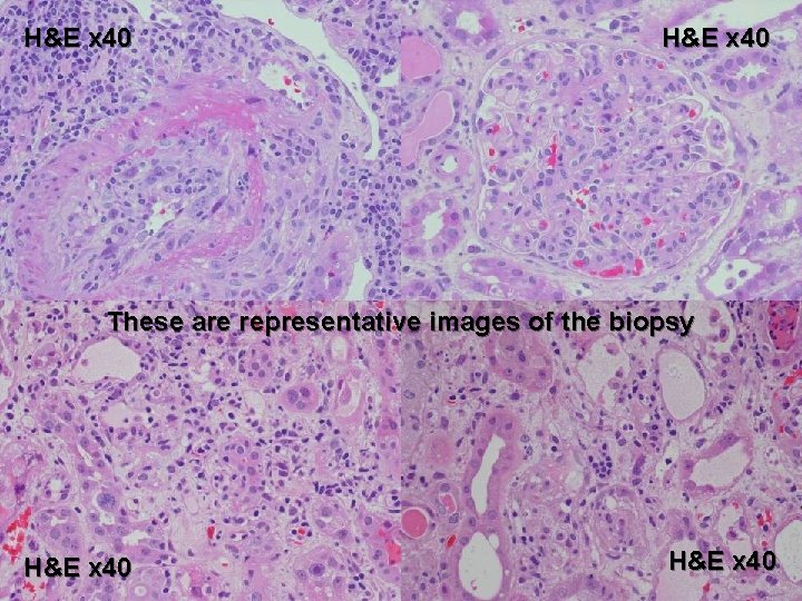 H&E x 40 These are representative images of the biopsy H&E x 40 