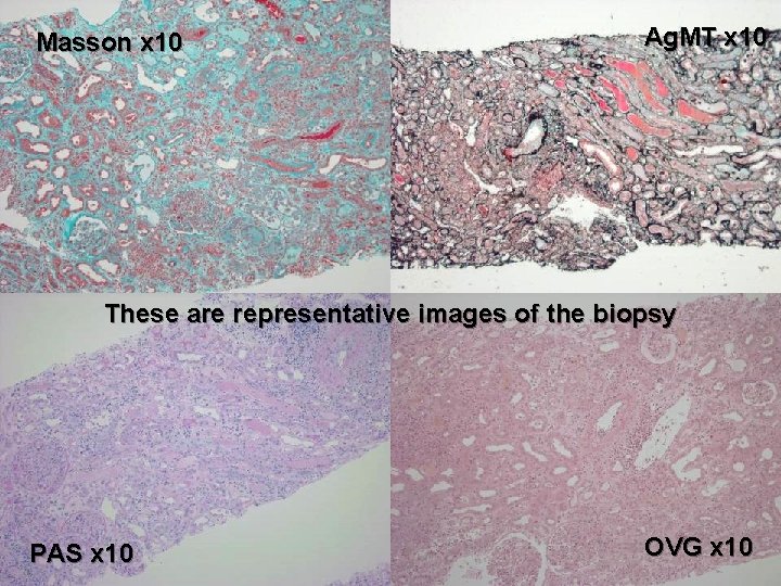 Masson x 10 Ag. MT x 10 These are representative images of the biopsy