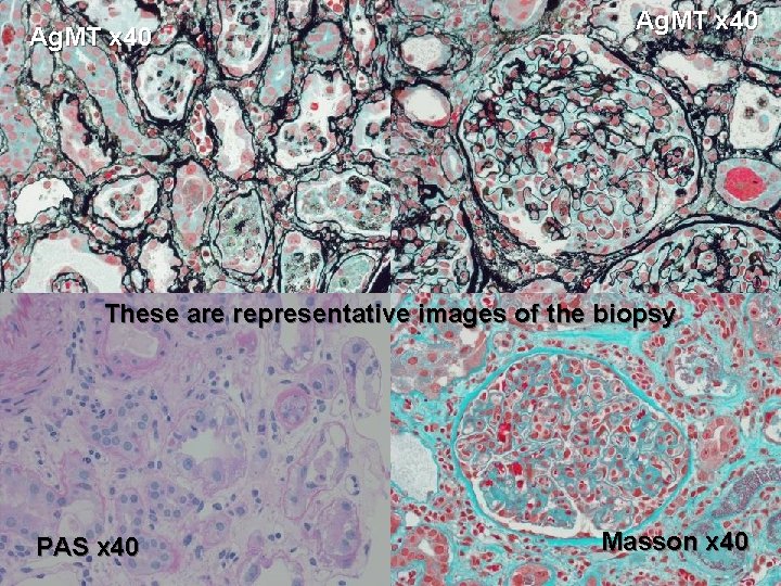 Ag. MT x 40 These are representative images of the biopsy PAS x 40