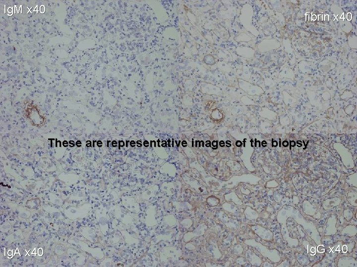 Ig. M x 40 fibrin x 40 These are representative images of the biopsy