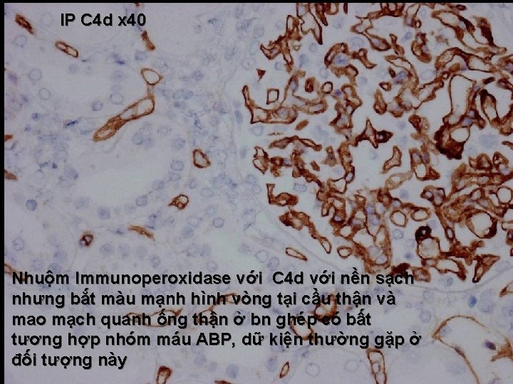 IP C 4 d x 40 Nhuộm Immunoperoxidase với C 4 d với nền