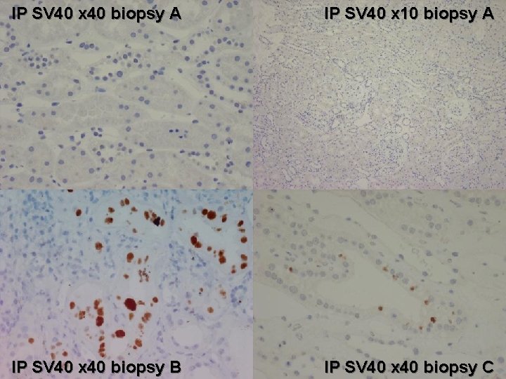 IP SV 40 x 40 biopsy A IP SV 40 x 10 biopsy A