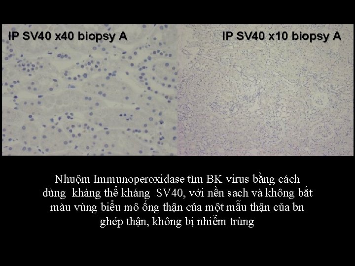 IP SV 40 x 40 biopsy A IP SV 40 x 10 biopsy A IP SV 40 x 40 biopsy A IP SV 40 x 10 biopsy A