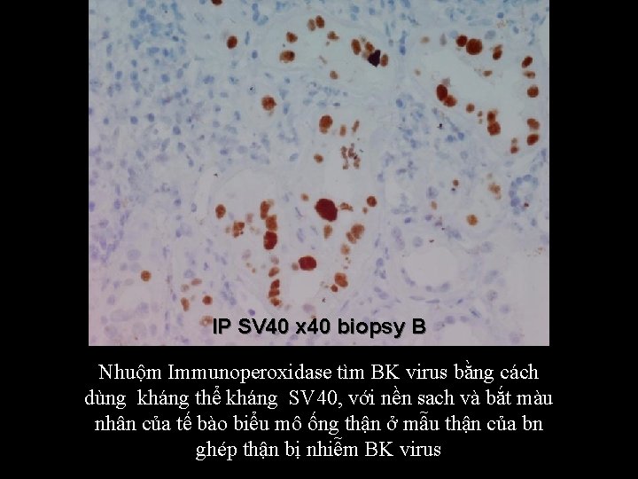 IP SV 40 x 40 biopsy B Nhuộm Immunoperoxidase tìm BK virus bằng cách