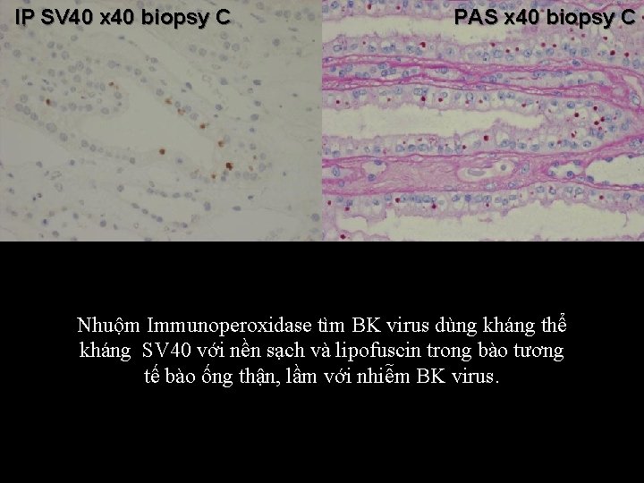 IP SV 40 x 40 biopsy C PAS x 40 biopsy C Nhuộm Immunoperoxidase
