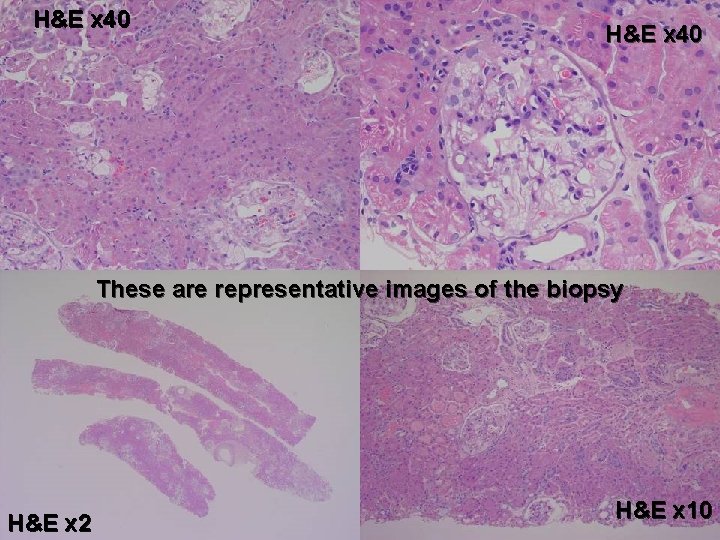 H&E x 40 These are representative images of the biopsy H&E x 2 H&E