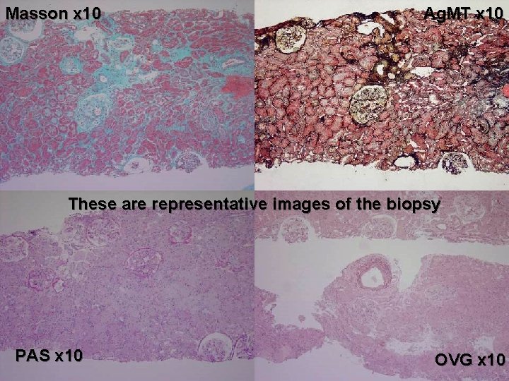 Masson x 10 Ag. MT x 10 These are representative images of the biopsy