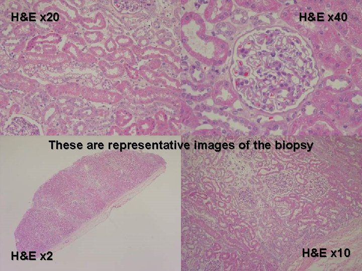 H&E x 20 H&E x 40 These are representative images of the biopsy H&E