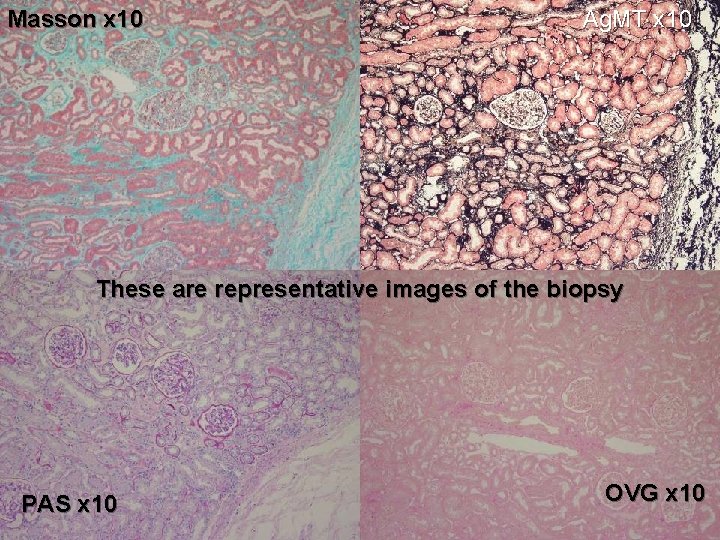 Masson x 10 Ag. MT x 10 These are representative images of the biopsy