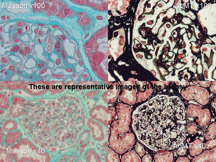 Masson x 100 Ag. MT x 100 These are representative images of the biopsy