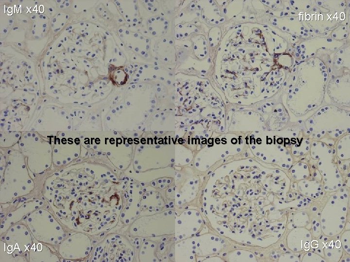 Ig. M x 40 fibrin x 40 These are representative images of the biopsy