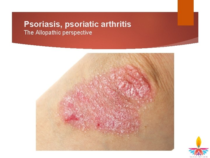 Psoriasis, psoriatic arthritis The Allopathic perspective 