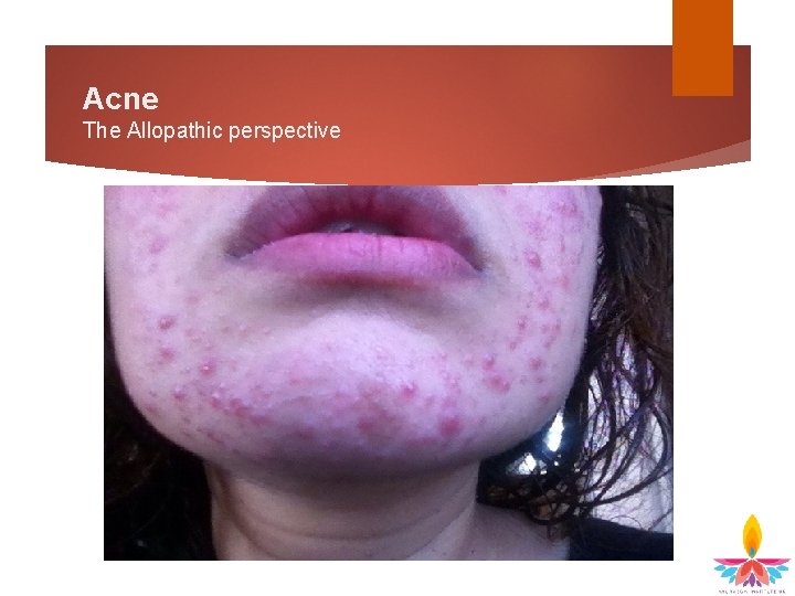 Acne The Allopathic perspective 