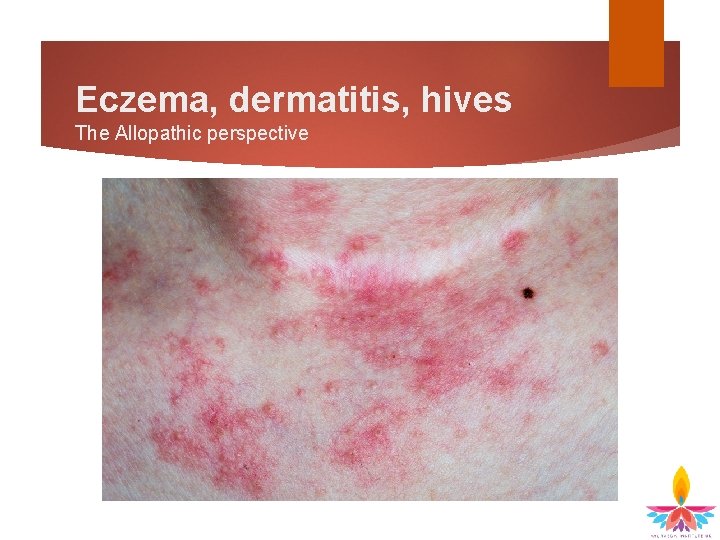 Eczema, dermatitis, hives The Allopathic perspective 