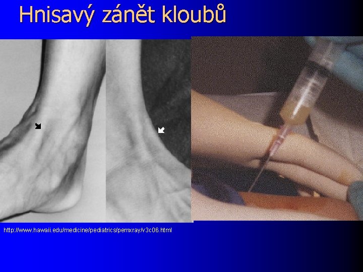 Hnisavý zánět kloubů http: //www. hawaii. edu/medicine/pediatrics/pemxray/v 3 c 06. html 