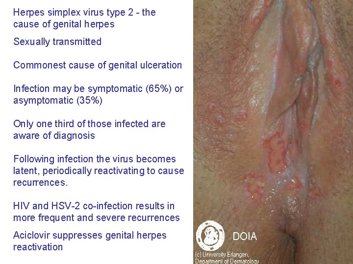 Herpes simplex virus type 2 - the cause of genital herpes Sexually transmitted Commonest