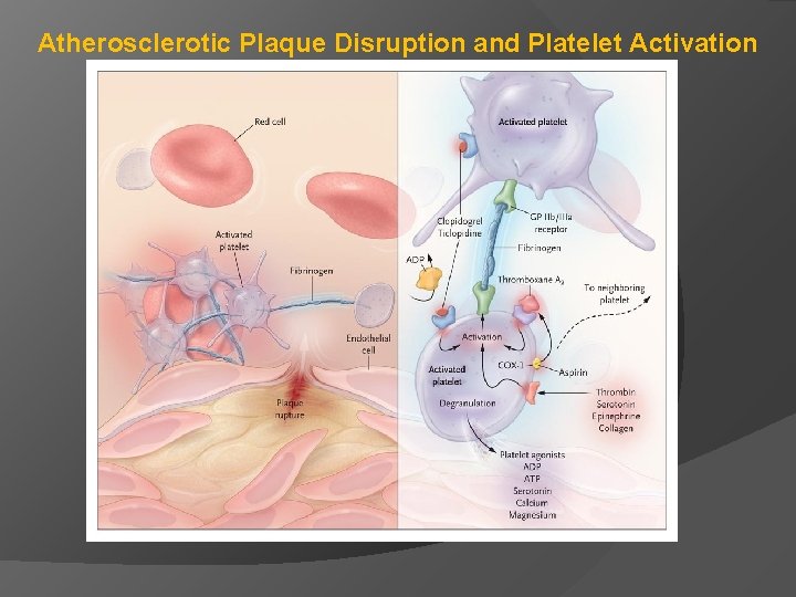 Atherosclerotic Plaque Disruption and Platelet Activation 