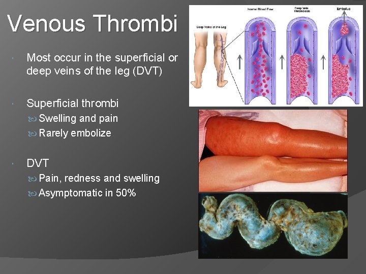 Venous Thrombi Most occur in the superficial or deep veins of the leg (DVT)