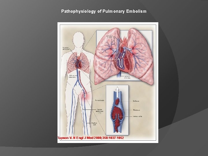 Pathophysiology of Pulmonary Embolism Tapson V. N Engl J Med 2008; 358: 1037 -1052