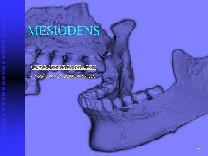 MESIODENS • DENS SUPERNUMERARIUS • DENS SUPPLEMENTARIUS 17 