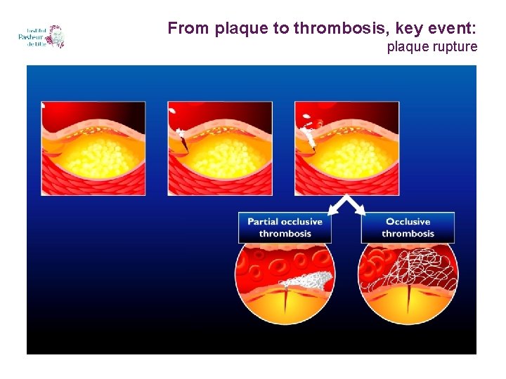 From plaque to thrombosis, key event: plaque rupture 