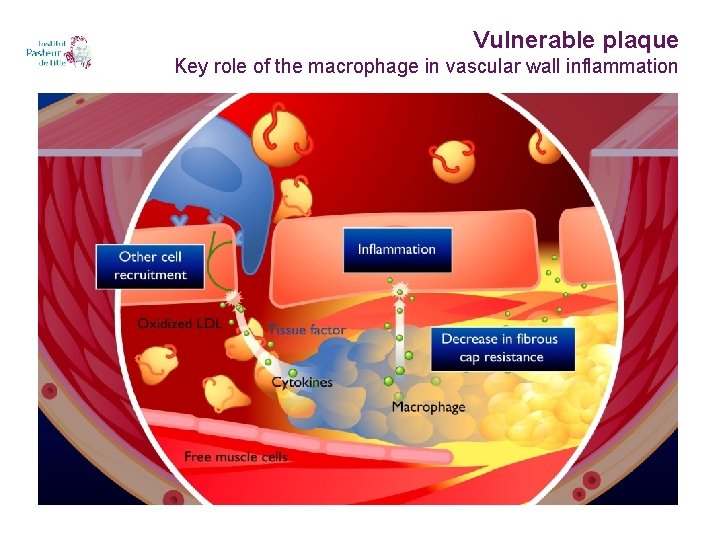 Vulnerable plaque Key role of the macrophage in vascular wall inflammation 