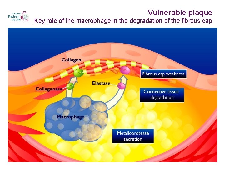 Vulnerable plaque Key role of the macrophage in the degradation of the fibrous cap