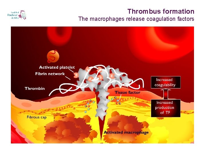 Thrombus formation The macrophages release coagulation factors 