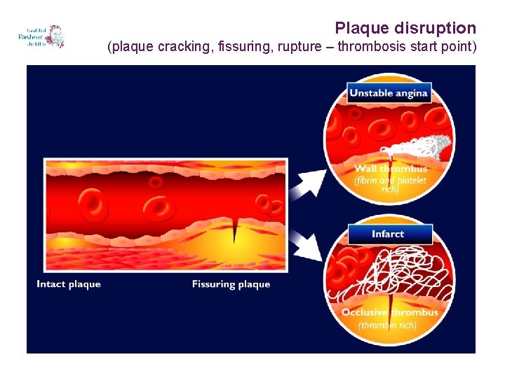 Plaque disruption (plaque cracking, fissuring, rupture – thrombosis start point) 