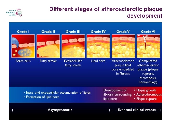 Different stages of atherosclerotic plaque development 