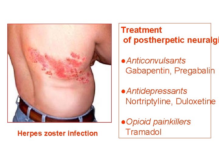 Treatment of postherpetic neuralgi ●Anticonvulsants Gabapentin, Pregabalin ●Antidepressants Nortriptyline, Duloxetine Herpes zoster infection ●Opioid