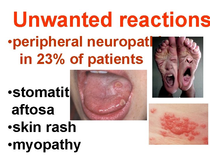 Unwanted reactions • peripheral neuropathies in 23% of patients • stomatitis aftosa • skin