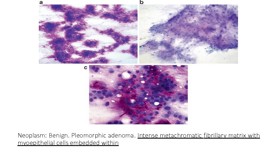 Neoplasm: Benign. Pleomorphic adenoma. Intense metachromatic fibrillary matrix with myoepithelial cells embedded within 