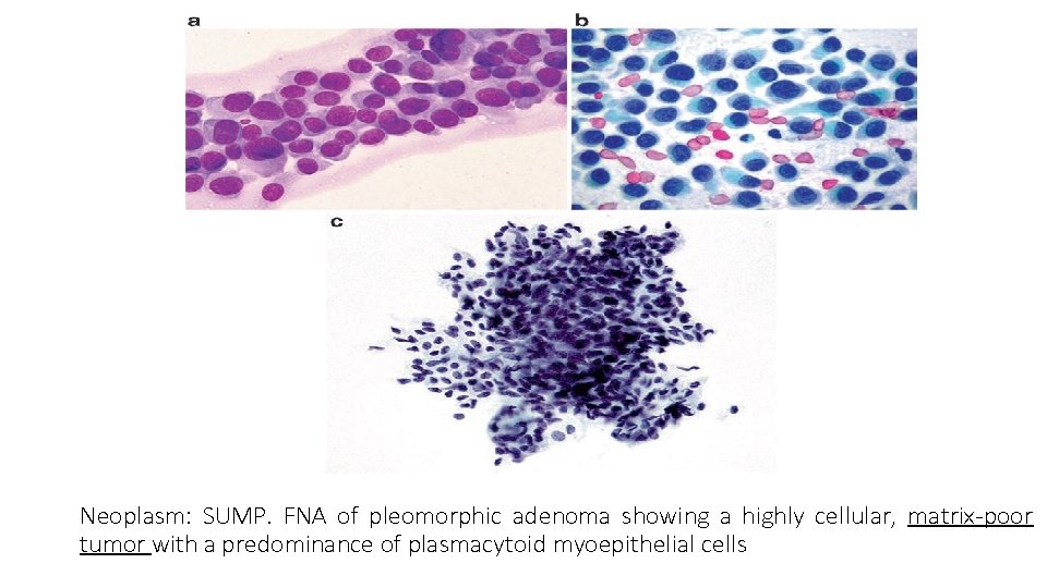 Neoplasm: SUMP. FNA of pleomorphic adenoma showing a highly cellular, matrix-poor tumor with a
